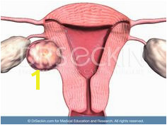 Fibroids are benign tumors non cancerous that grow from muscle layers of the uterus