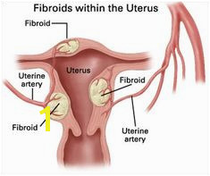 Fibroid on uterus wall treatment uterine fibroid ppt is a fibroid tumor the same as a cyst signs of early fibroid fibroid uterus define uterine fibroid