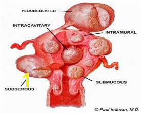 fibroid locations Uterine
