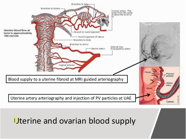 Fibroid therapy Focal High Frequency Ultrasound HFU