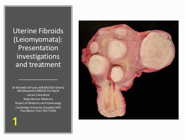 uterine fibroids leiomyomata investigations and treatment 1 638