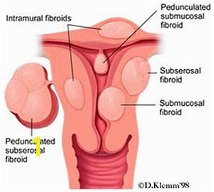 Mural Fibroid In Uterus Uterine Fibroids Uterine Fibroid Embolization Uterine Fibroids