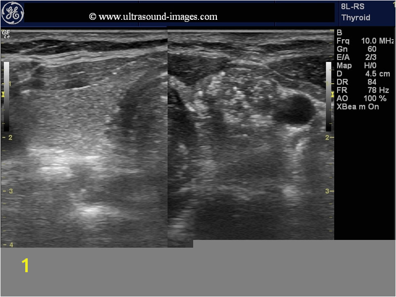 dense calcific colloid nodule