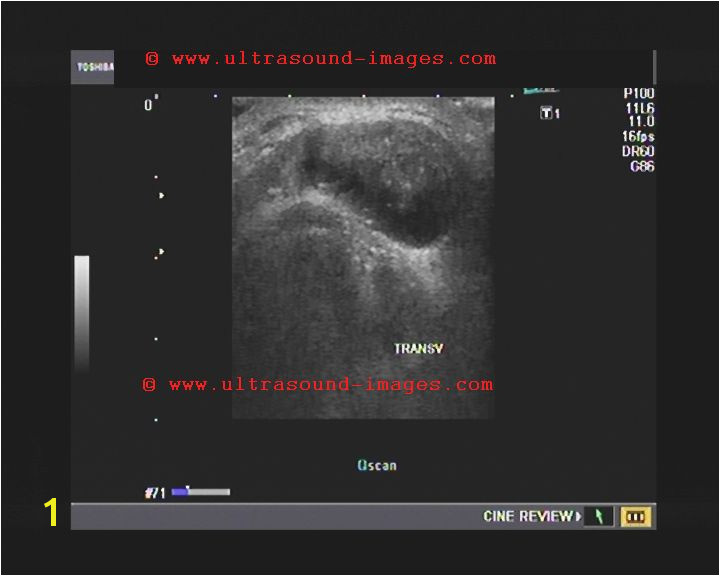 Mural Nodule Thyroid A Gallery Of High Resolution Ultrasound Color Doppler & 3d