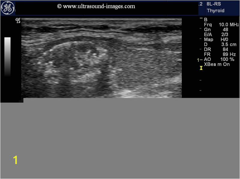 dense calcific colloid nodule