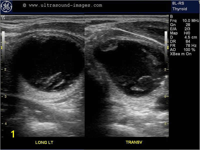 Mural Nodule Thyroid A Gallery Of High Resolution Ultrasound Color Doppler & 3d