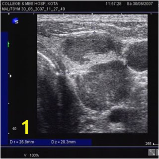 US Image shows hypoechoic lesions with irregular margins in left lobe of thyroid