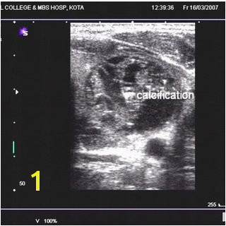 US Image shows hypoechoic lesions with irregular margins in left lobe of thyroid Colloid goiter