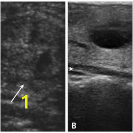 A 56 year old woman with a thyroid nodule in the right thyroid on