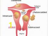 Mural Fibroid In Uterus 22 Best Uterine Fibroids Images