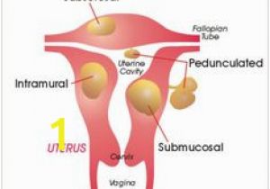 Mural Fibroid In Uterus 22 Best Uterine Fibroids Images