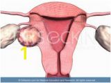 Mural Fibroid In Uterus 29 Best Uterine Fibroids Images