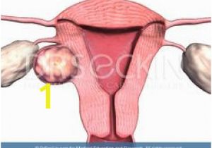 Mural Fibroid In Uterus 29 Best Uterine Fibroids Images