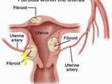 Mural Fibroid In Uterus 73 Best Uterine Fibroids Advice Images