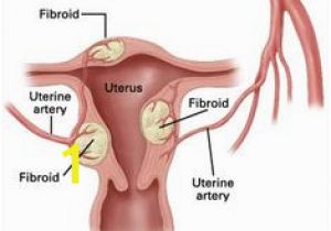 Mural Fibroid In Uterus 73 Best Uterine Fibroids Advice Images