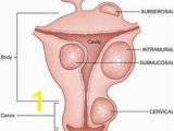 Mural Fibroid In Uterus 8 Best Myoma Images
