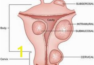Mural Fibroid In Uterus 8 Best Myoma Images