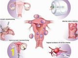 Mural Fibroid In Uterus Pdf Uterine Fibroid Management From the Present to the Future