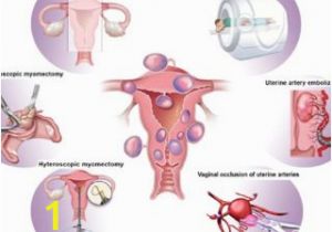 Mural Fibroid In Uterus Pdf Uterine Fibroid Management From the Present to the Future