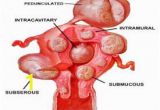 Mural Fibroid In Uterus Types Of Uterine Fibroids