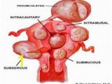 Mural Fibroid In Uterus Types Of Uterine Fibroids