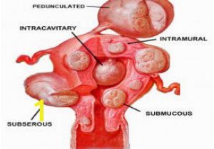 Mural Fibroid In Uterus Types Of Uterine Fibroids