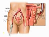 Mural Fibroid In Uterus Understanding Uterine Fibroid Size How Big is too Big