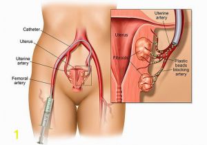 Mural Fibroid In Uterus Understanding Uterine Fibroid Size How Big is too Big