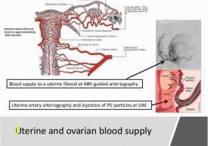 Mural Fibroid In Uterus Uterine Fibroids Leiomyomata Investigations and Treatment