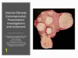 Mural Fibroid In Uterus Uterine Fibroids Leiomyomata Investigations and Treatment