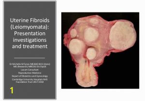 Mural Fibroid In Uterus Uterine Fibroids Leiomyomata Investigations and Treatment