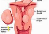 Mural Fibroid In Uterus Uterine Fibroids Uterine Fibroid Embolization Uterine Fibroids