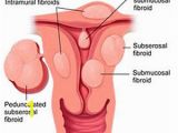 Mural Fibroid In Uterus Uterine Fibroids Uterine Fibroid Embolization Uterine Fibroids