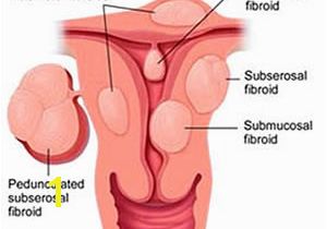 Mural Fibroid In Uterus Uterine Fibroids Uterine Fibroid Embolization Uterine Fibroids