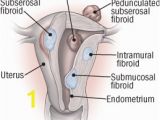 Mural Fibroid In Uterus What to Do About Fibroids Harvard Health