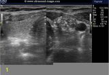 Mural Nodule Thyroid A Gallery Of High Resolution Ultrasound Color Doppler & 3d