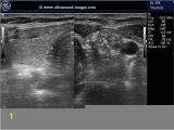 Mural Nodule Thyroid A Gallery Of High Resolution Ultrasound Color Doppler & 3d