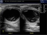 Mural Nodule Thyroid A Gallery Of High Resolution Ultrasound Color Doppler & 3d