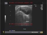 Mural Nodule Thyroid A Gallery Of High Resolution Ultrasound Color Doppler & 3d