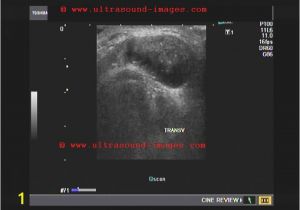 Mural Nodule Thyroid A Gallery Of High Resolution Ultrasound Color Doppler & 3d