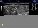 Mural Nodule Thyroid A Gallery Of High Resolution Ultrasound Color Doppler & 3d