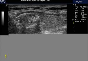 Mural Nodule Thyroid A Gallery Of High Resolution Ultrasound Color Doppler & 3d