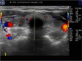 Mural Nodule Thyroid A Gallery Of High Resolution Ultrasound Color Doppler & 3d