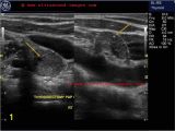 Mural Nodule Thyroid A Gallery Of High Resolution Ultrasound Color Doppler & 3d