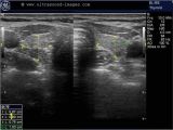 Mural Nodule Thyroid A Gallery Of High Resolution Ultrasound Color Doppler & 3d