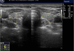 Mural Nodule Thyroid A Gallery Of High Resolution Ultrasound Color Doppler & 3d