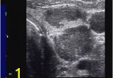 Mural Nodule Thyroid Pdf Evaluation Of Thyroid Nodules by Gray Scale and Doppler