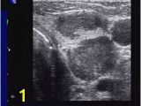 Mural Nodule Thyroid Pdf Evaluation Of Thyroid Nodules by Gray Scale and Doppler