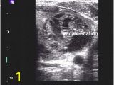 Mural Nodule Thyroid Pdf Evaluation Of Thyroid Nodules by Gray Scale and Doppler