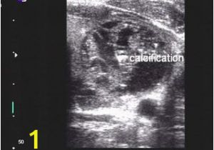 Mural Nodule Thyroid Pdf Evaluation Of Thyroid Nodules by Gray Scale and Doppler